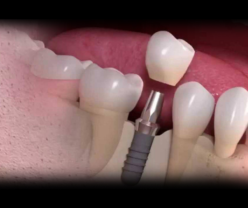 ایمپلنت دندان در کلینیک دندانپزشکی ریحانه