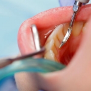 جراحی لثه کلینیک دندانپزشکی ریحانه