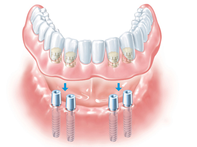 ایمپلنت دندان
